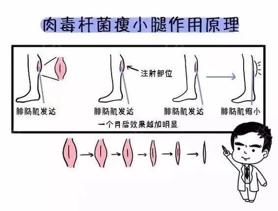 如何消除肌肉腿进阶细长腿?