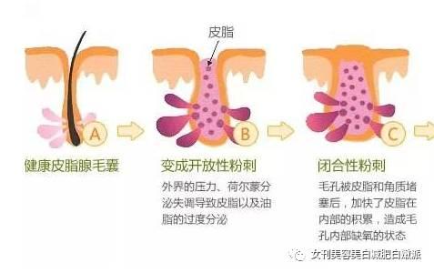 女刊:原来娜扎脸上的闭口这么严重|娜扎|闭口|粉刺