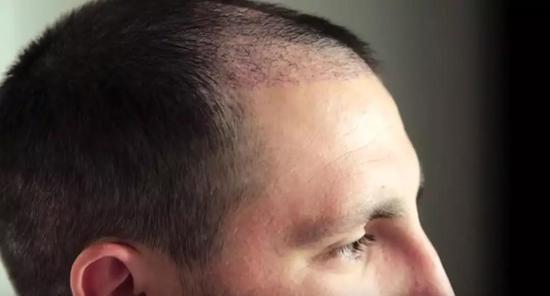 植发手术10天后的Paul的全新发际线隐隐可见