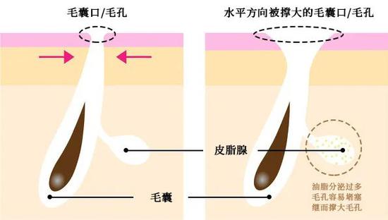 缩毛孔效果不大？对抗毛孔问题还是得来点硬的