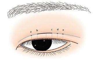 双眼皮手术