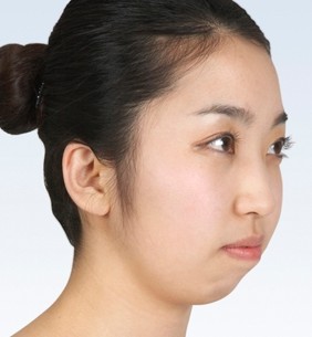 下巴短缩有什么后果?|下巴|嘴凸