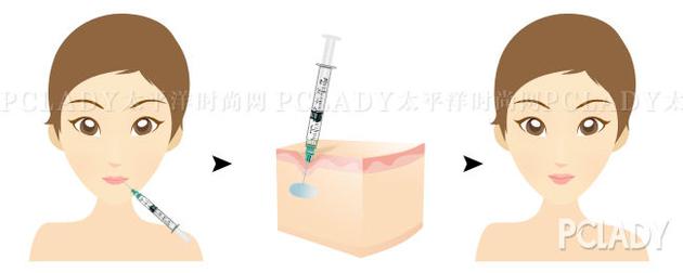 玻尿酸注射丰唇 可爱又性感