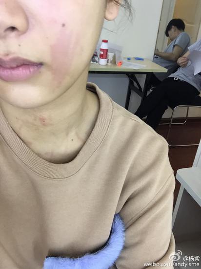 杨紫遭遇荨麻疹（图片来源：杨紫新浪微博）