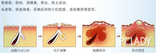 痘痘爆发过程