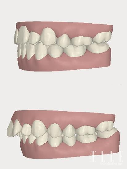 正确咬合（上）错误咬合（下）