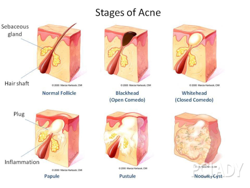 痘痘示意图1
