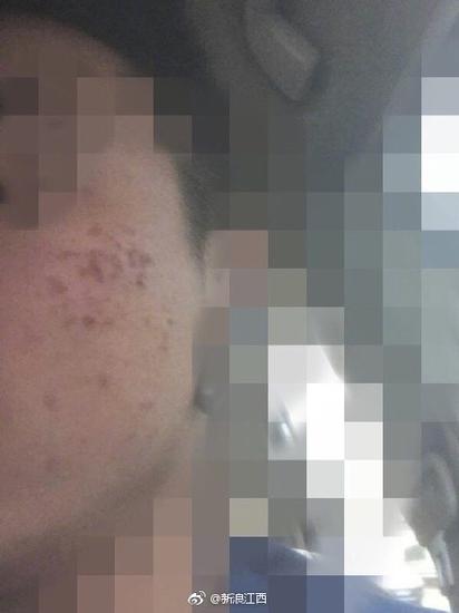 学生晒出脸部红肿糜烂的照片（图片来源：@新浪江西 新浪微博）