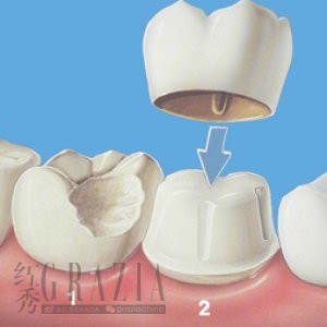 美容冠 烤瓷牙