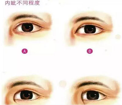 开眼角会留下明显的疤痕吗?|内眦赘皮|开眼角|疤痕_新浪女性_新浪网