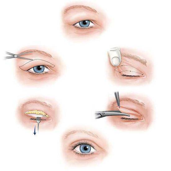 割双眼皮必知这7大事项|双眼皮手术|割双眼皮|双眼皮_新浪女性_新浪网
