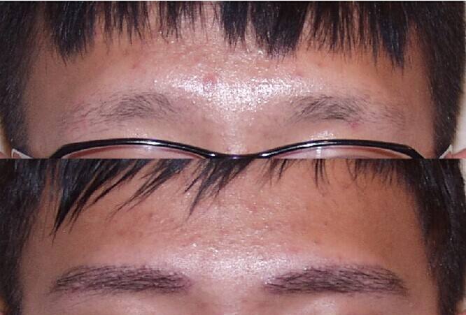 自体毛发移植眉毛有何优势|眉毛|自体|毛发