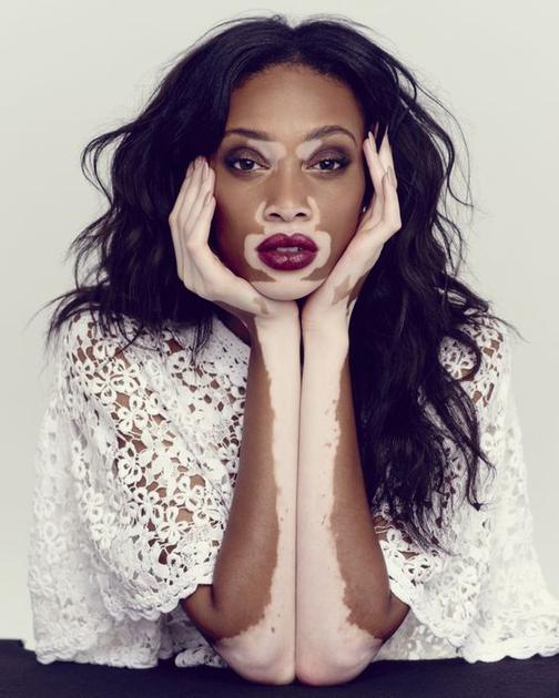 Winnie Harlow