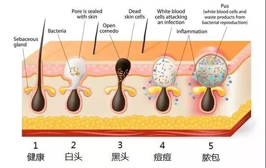 痘痘的发展历程