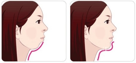 如果下巴和下颌线这部分变得“肉肉”的，就会视觉上给人脸部不够纤瘦的感觉，侧面也缺乏立体感。