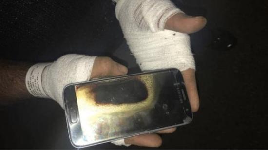 Amarjit Mann的手和手腕均被烧伤。来源：Gizmodo