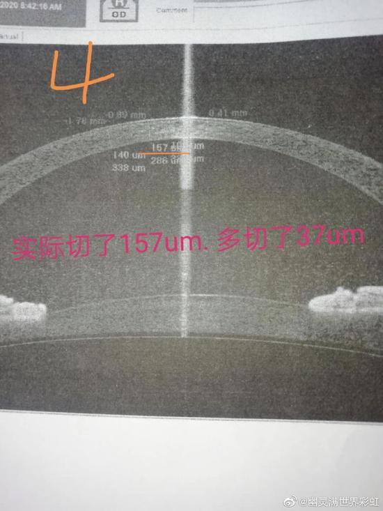 又一例爱尔眼科前员工术后视力仅005武汉医生艾芬转发声援