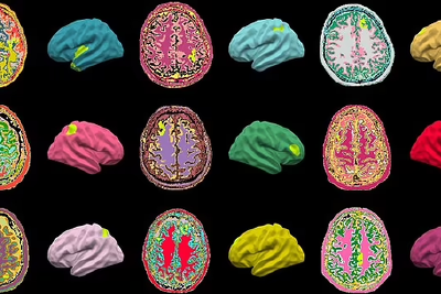 AI算法能检测大脑缺陷，有助于治疗癫痫疾病