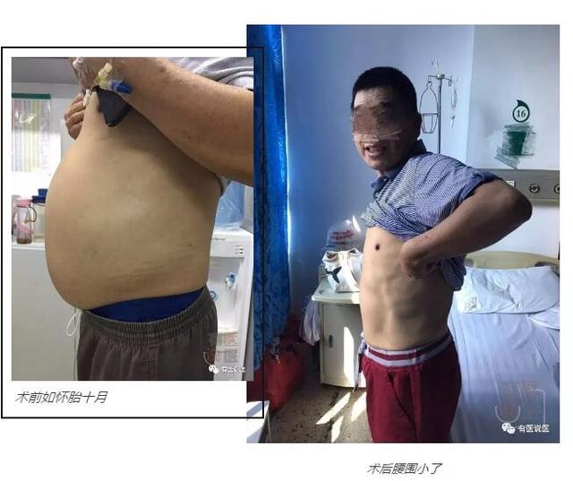 陈先生今年55岁,南平人,但在福州工作生活了十余年。他说,从今年4月开始,他感觉人疲劳,后在体检中查出肝硬化。