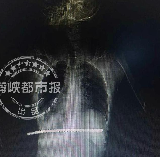 消防员协助手术 凌晨3点才归队