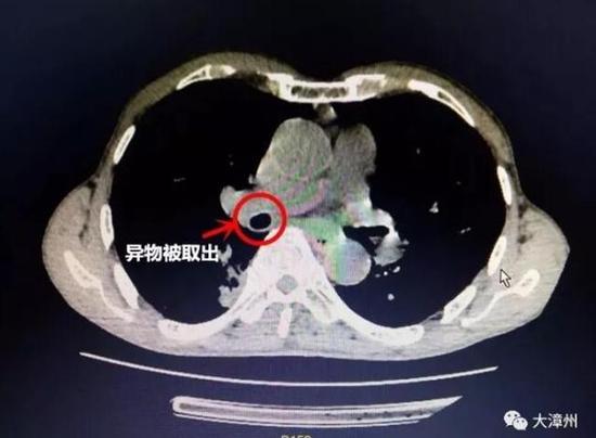 ▲谢添成判断郭老伯患有右下肺支气管异物伴阻塞性肺炎