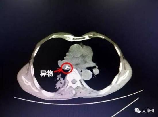 据郭老伯讲述,先前他因一次饮食,发生阵发刺激性咳呛,接下来的4个月内,