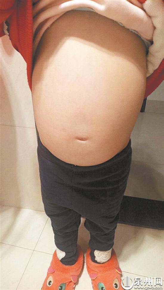 小雯肝脾肿大,所以肚子特别大。