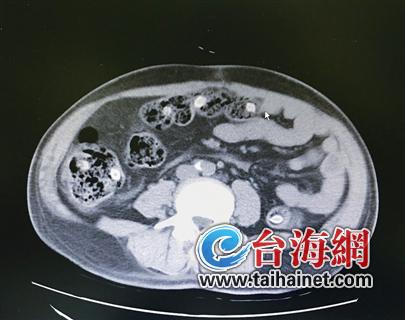 ▲CT检查肠腔内有10多处核状异物