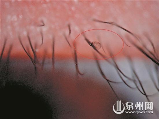 附着在睫毛上的虱子虫卵