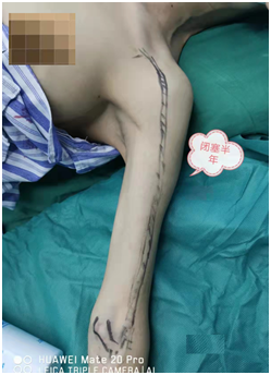 术前手臂