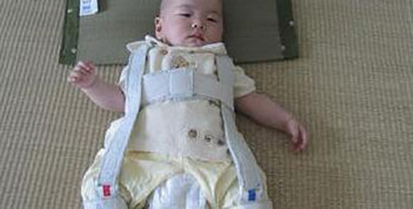 1岁宝宝走路摇晃,发现大腿不对称,医院检查后