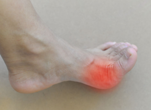 痛风这4类食物最好别贪嘴,小心肾衰竭,在