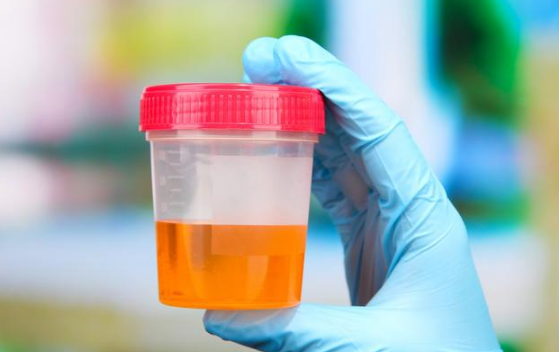 尿蛋白不转阴一定会尿毒症?这3种肾病是例外