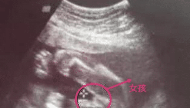 怀孕四个月宝宝b超能看出"胎儿的性别"吗?