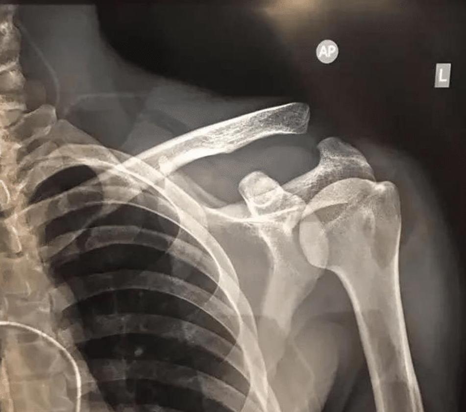 好消息武磊肩伤无碍可以比赛! 我们是不是之前