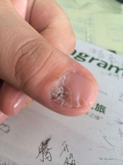3岁女童手指甲莫名脱落,罪魁祸首原来是这种病,家长要当心!