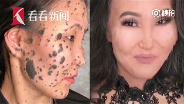化妆师展“换脸”神技 满脸黑斑女子变无暇美肌