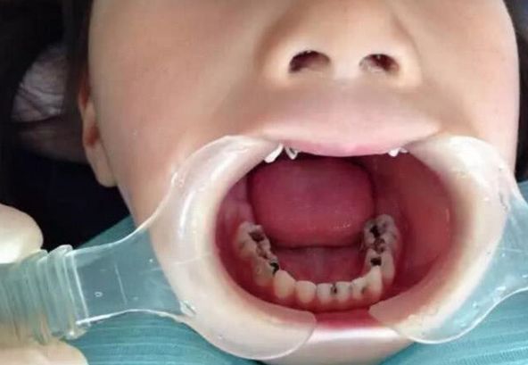 6岁女儿从不吃糖牙齿却烂光,去检查后,医生大骂婆婆无
