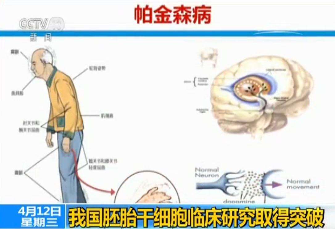 全球首款多能干细胞疗法最新进展,已治疗10名