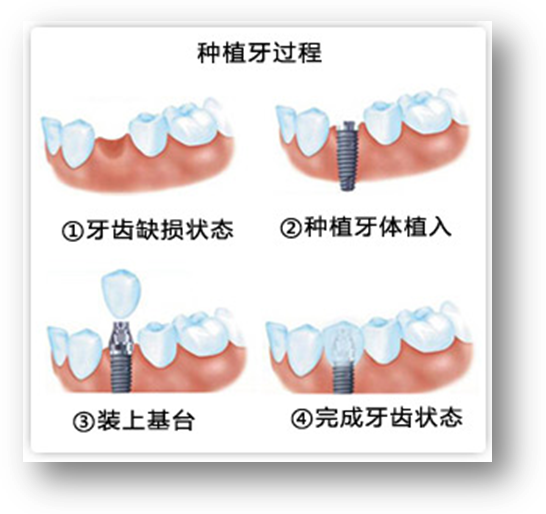 九旬老伯种牙享口福,种植牙年龄创新纪录!