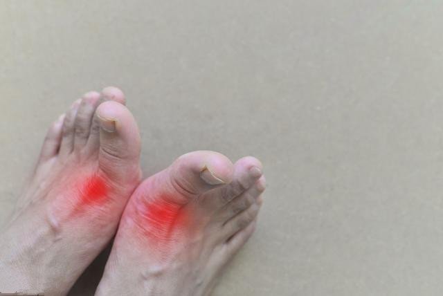 高尿酸多是吃出来的,医生提醒:不想肾衰竭,这