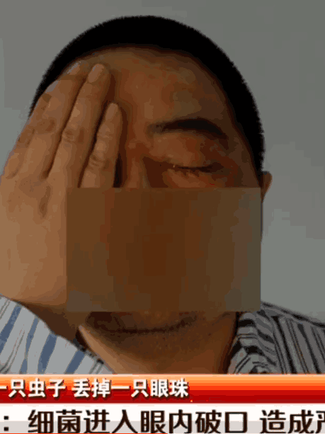 无意拍死脸上的昆虫, 不仅视力下降, 眼球还要被摘除