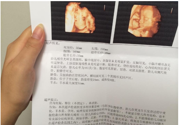 四维彩超很重要,隐藏了胎儿小秘密,看不懂4个数据就白做