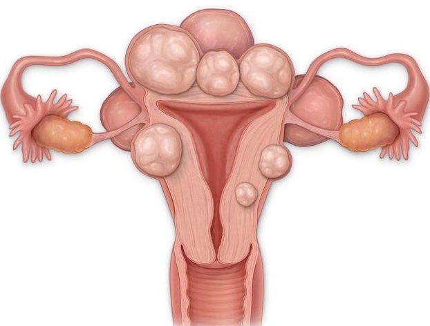41岁备孕,发现子宫肌瘤,如何抉择?