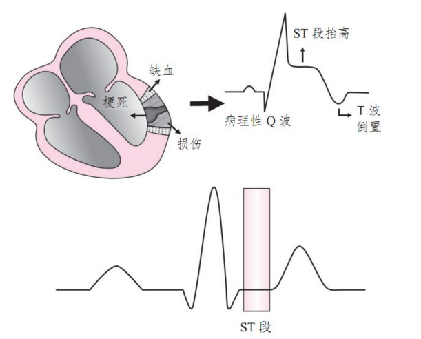急性心肌梗死的心电图快速定位及临床意义