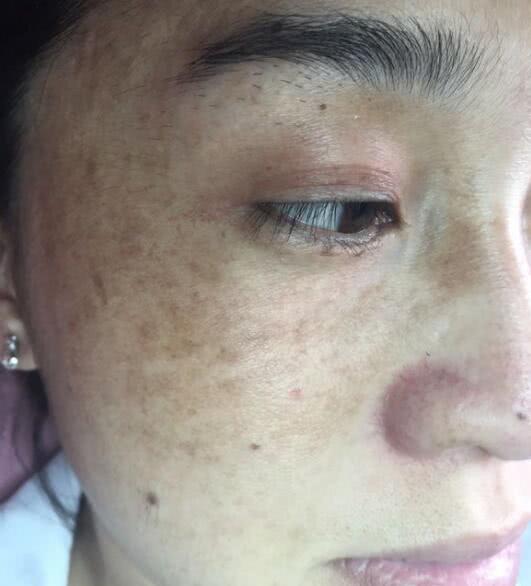 黄褐斑病例咨询回复:左脸颊,铜钱大小,暗灰色,面部发黑无光泽