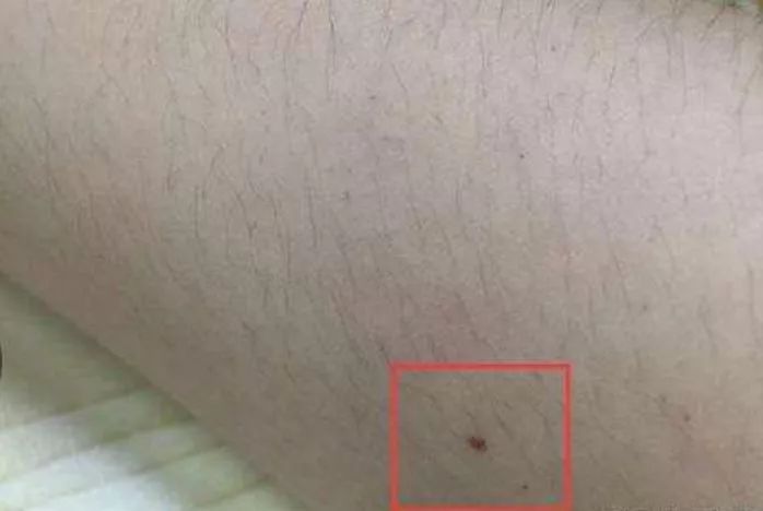 若皮肤出现了这种"痣",可能是"肝病"来临的前兆,早看