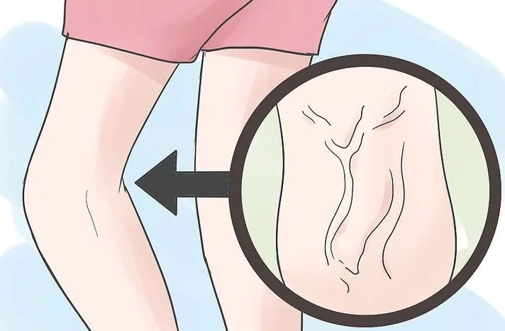 静脉曲张出现在这个羞羞的地方,男人小心,你的精子