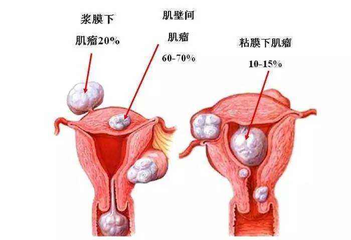 学员反馈:艾灸治疗子宫肌瘤效果很好