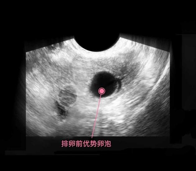 胎儿从卵泡到孕17周，17张图片清晰诠释，男宝女宝看得很清楚